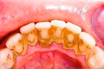 Chuyên gia chỉ rõ lý do viêm lợi và cách chữa