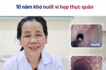Cắt màng ngăn thực quản giúp người bệnh 56 tuổi thoát khỏi nuốt nghẹn 10 năm