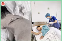 Bệnh nhân bị vi khuẩn ăn thịt người tấn công cổ: Bác sĩ chỉ cách tránh