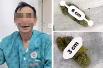 Ăn măng từ Tết, sau gần nửa năm người đàn ông mới mổ tắc ruột