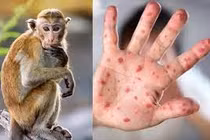 Mầm bệnh đậu mùa khỉ đã xâm nhập trong cộng đồng