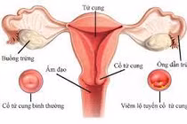 Rỉ máu liên tục vì đốt lộ tuyến không đúng phương pháp