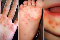 TPHCM: Bệnh tay chân miệng giảm nhẹ