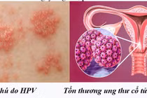 Chuyên gia mách cách phòng ngừa virus HPV gây nhiều bệnh ung thư ở người