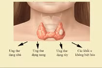 Hoãn mổ ung thư tuyến giáp thể nhú, liệu có di căn?