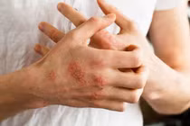 Khắc phục chứng ngứa da vào mùa đông