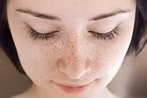 Chuyên gia mách cách chữa trị và phòng ngừa tàn nhang