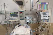Cứu trẻ 39 ngày tuổi ngưng thở do nhiễm virus hợp bào hô hấp