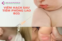 Bác sĩ chỉ cách xử trí viêm hạch sau tiêm phòng vắc xin lao