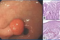 Polyp u tuyến dạ dày có ung thư?