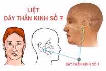 Cách tránh miệng và mắt méo lệch do trời lạnh