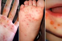 Bệnh Tay chân miệng vào mùa, phụ huynh cần biết gì để bảo vệ con?