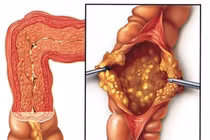 Tự ý dùng kháng sinh cụ bà 81 tuổi bị suy thận, viêm đại tràng nặng