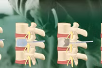 Bác sĩ chỉ rõ các phương pháp điều trị xẹp đốt sống do loãng xương