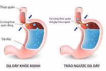 Vì sao điều trị trào ngược dạ dày thực quản nhiều cách nhưng lâu khỏi?