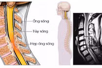 Tắm muộn, nữ sinh 20 tuổi đột ngột bị yếu liệt tay chân do viêm tủy