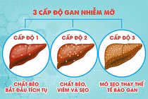 Địa chỉ vàng: Thực phẩm chức năng hỗ trợ gan nhiễm mỡ