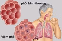 Cách điều trị viêm phổi mắc phải cộng đồng tại nhà