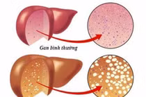 Gan nhiễm mỡ - kẻ giết người thầm lặng, cách gì phòng ngừa