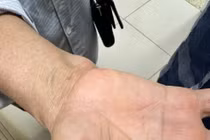  Ấu trùng giun đũa chó mèo nổi trên tay bệnh nhân.