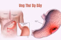 Dấu hiệu cảnh báo sớm ung thư dạ dày chớ nên bỏ qua