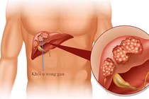 Bác sĩ mách cách thay đổi lối sống phòng ung thư