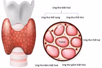 Nhóm người có nguy cơ mắc ung thư tuyến giáp 