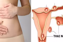 Uống thuốc đình chỉ thai tại nhà, cô gái 20 tuổi bị vỡ tử cung