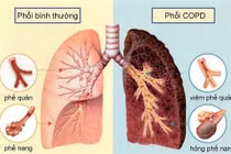 Dấu hiệu khi ngủ cảnh báo bệnh phổi nguy hiểm