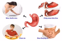 Bác sĩ mách bí quyết giảm cơn đau viêm dạ dày cấp