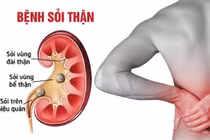 Những thói quen thường ngày là “hung thủ” gây sỏi thận