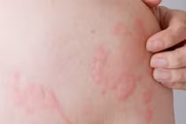 Bác sĩ chỉ rõ dị ứng, mày đay có phải do suy giảm chức năng gan?