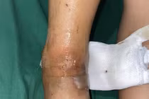 Bị rắn độc cắn, bé trai bị rối loạn đông máu, bàn chân tổn thương nặng