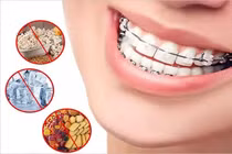 Niềng răng cần kiêng thức ăn gì?