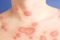 Địa chỉ vàng: Bệnh viện có khả năng chẩn đoán bệnh Lupus ban đỏ