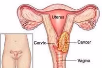 Phụ nữ trẻ muốn sàng lọc ung thư cổ tử cung hãy làm cách này