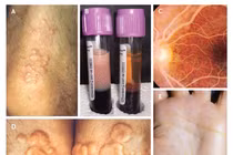 Tăng Triglycerid máu nặng chữa như thế nào?