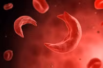 Chỉnh sửa gene điều trị bệnh hồng cầu hình liềm