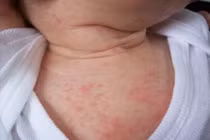 Gợi ý 5 loại thực phẩm tốt cho trẻ bị rôm sảy