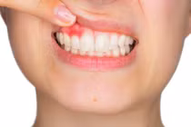 Dấu hiệu nhận biết bị viêm lợi, cần lưu ý