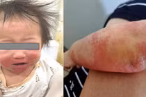 Cảnh giác viêm da cơ địa ở trẻ nhỏ trong mùa hanh khô