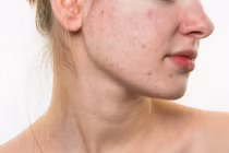 Dấu hiệu nhận biết làn da bị nhiễm độc corticoid