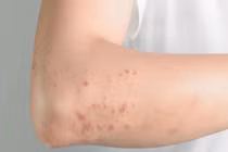 Bị ngứa 10 năm mới biết nhiễm giun đũa chó mèo