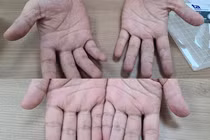 Nhiều người vào viện cầu cứu vì bệnh da mùa mưa