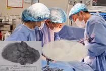 Đau bụng âm ỉ kéo dài, người phụ nữ đi khám phát hiện điều bất ngờ