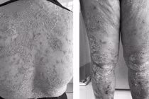 Bệnh vảy nến: Sự kỳ thị là nỗi ám ảnh
