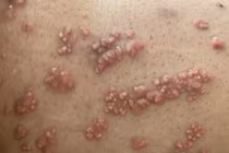 U nổi khắp người do rối loạn mỡ máu: Dễ tai biến mạch máu não