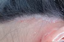 Nguyên nhân bị vảy nến da đầu và cách cải thiện từ thảo dược