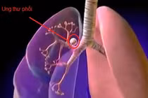 Không hút thuốc lá có bị ung thư phổi không?