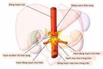 Kỹ thuật giảm đau bụng bằng diệt đám rối thần kinh tạng